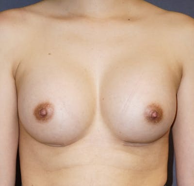 Breast Augmentation Before & After Gallery - Patient 345571 - Image 2