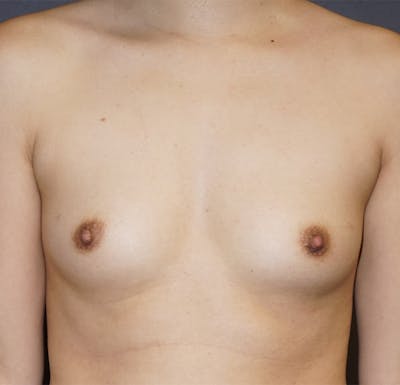 Breast Augmentation Before & After Gallery - Patient 345571 - Image 1
