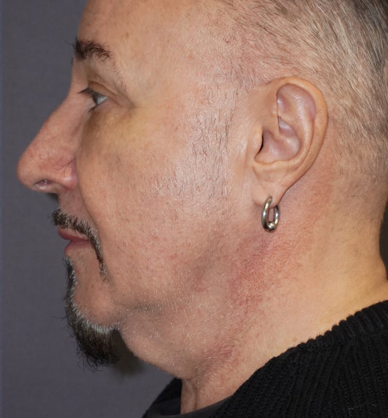 Neck Liposuction Before & After Gallery - Patient 255019 - Image 1
