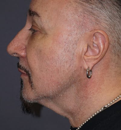 Neck Liposuction Before & After Gallery - Patient 255019 - Image 2