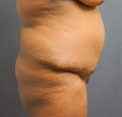 Tummy Tuck Before & After Gallery - Patient 224651 - Image 1