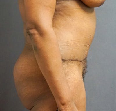 Tummy Tuck Before & After Gallery - Patient 224651 - Image 2