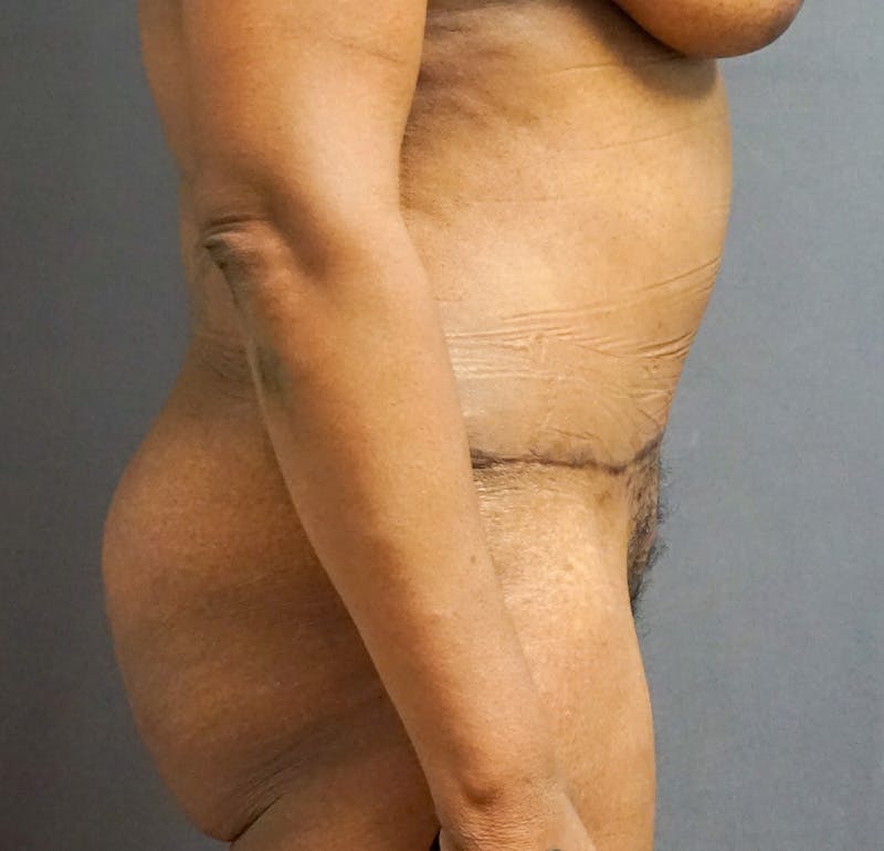 Tummy Tuck Before & After Gallery - Patient 224651 - Image 2