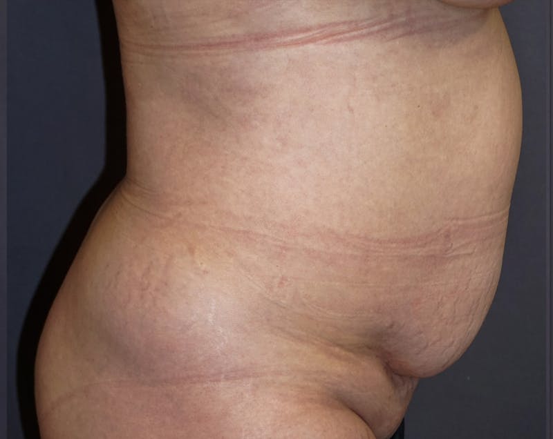 Tummy Tuck Before & After Gallery - Patient 392537 - Image 5