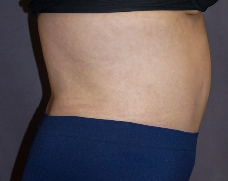 Tummy Tuck Before & After Gallery - Patient 392537 - Image 6
