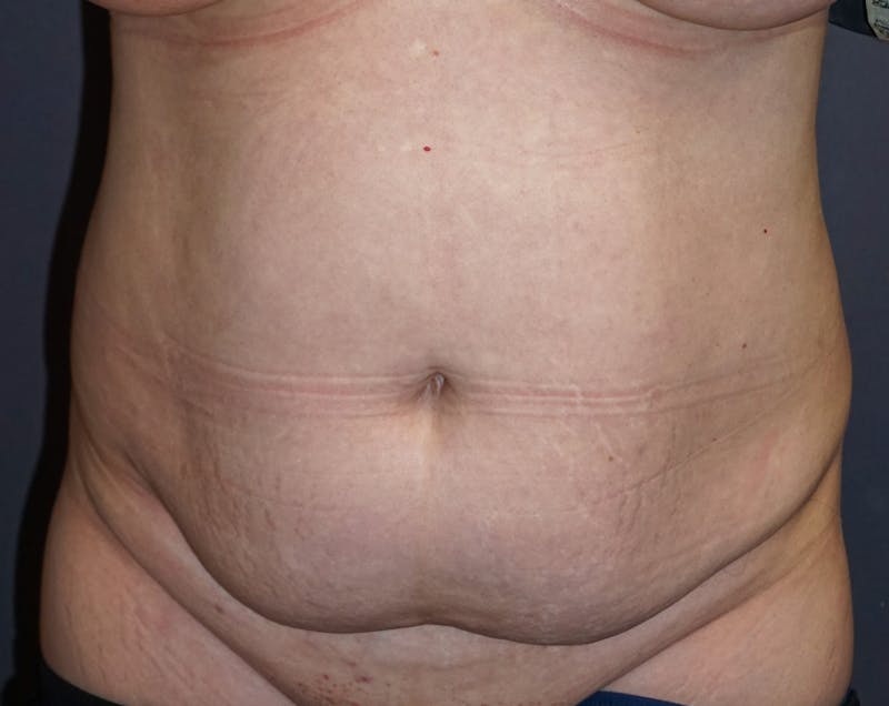 Tummy Tuck Before & After Gallery - Patient 392537 - Image 1