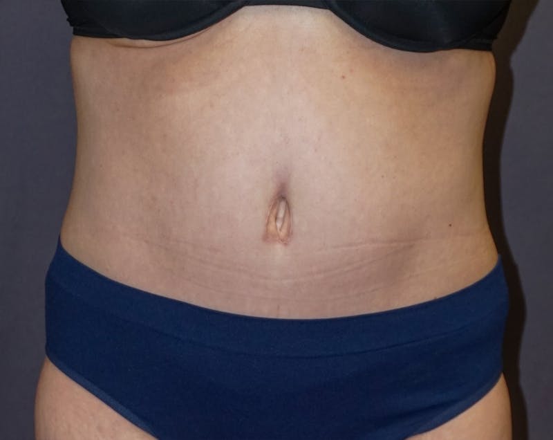 Tummy Tuck Before & After Gallery - Patient 392537 - Image 2