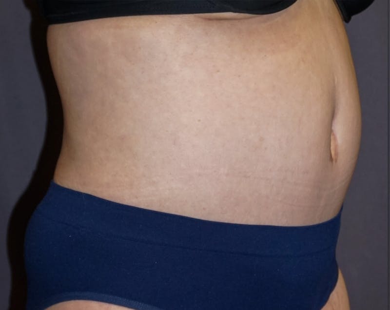 Tummy Tuck Before & After Gallery - Patient 392537 - Image 4