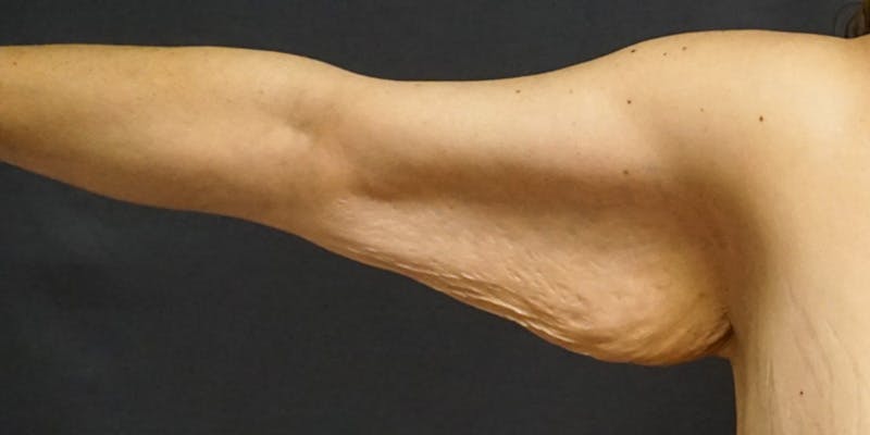 Brachioplasty Before & After Gallery - Patient 252329 - Image 5