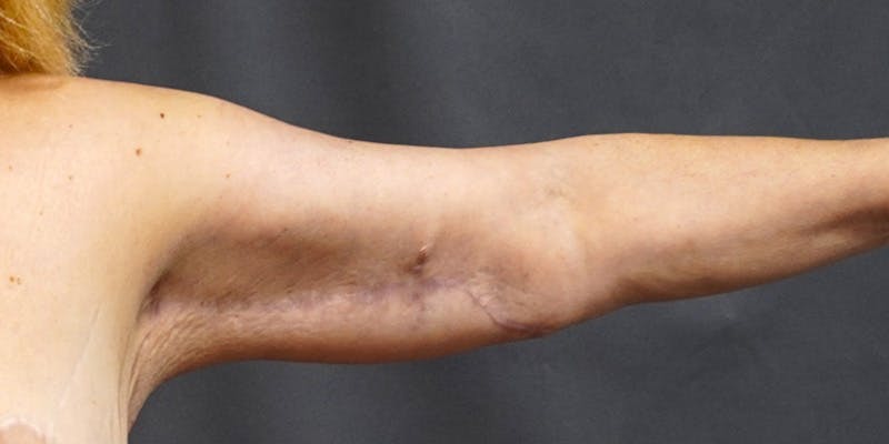Brachioplasty Before & After Gallery - Patient 252329 - Image 8