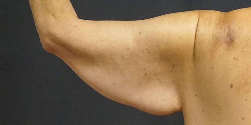 Brachioplasty Before & After Gallery - Patient 252329 - Image 3