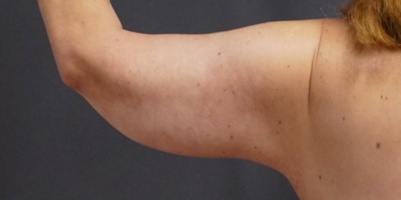 Brachioplasty Before & After Gallery - Patient 252329 - Image 4