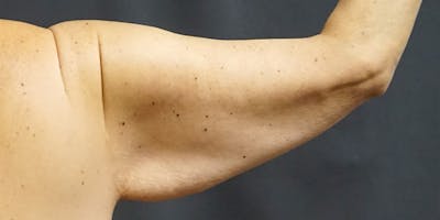Brachioplasty Before & After Gallery - Patient 252329 - Image 1