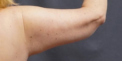 Brachioplasty Before & After Gallery - Patient 252329 - Image 2
