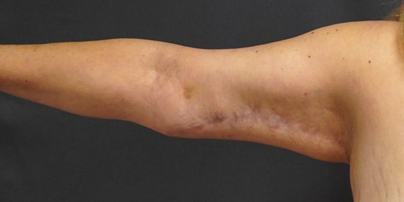 Brachioplasty Before & After Gallery - Patient 252329 - Image 6