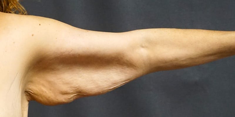 Brachioplasty Before & After Gallery - Patient 252329 - Image 7