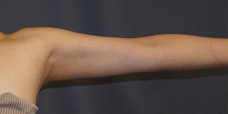 Liposuction Before & After Gallery - Patient 182228 - Image 1