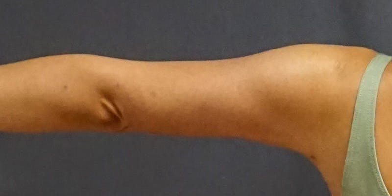 Liposuction Before & After Gallery - Patient 182228 - Image 8