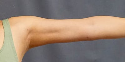 Liposuction Before & After Gallery - Patient 182228 - Image 2