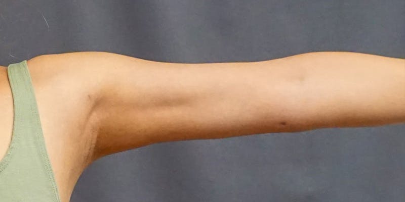 Liposuction Before & After Gallery - Patient 182228 - Image 2