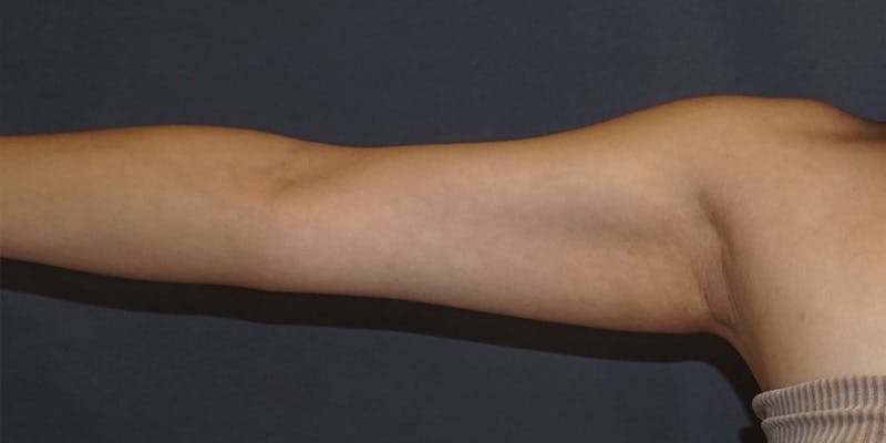 Liposuction Before & After Gallery - Patient 182228 - Image 5