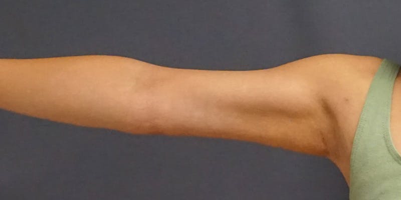 Liposuction Before & After Gallery - Patient 182228 - Image 6