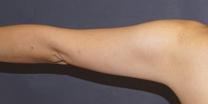 Liposuction Before & After Gallery - Patient 182228 - Image 7
