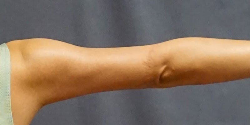 Liposuction Before & After Gallery - Patient 182228 - Image 4