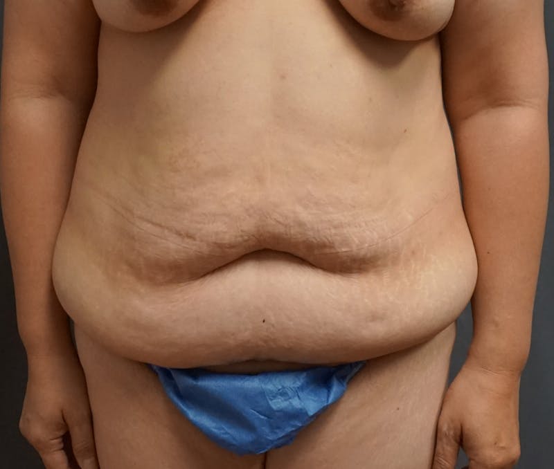 Tummy Tuck Before & After Gallery - Patient 169452 - Image 1