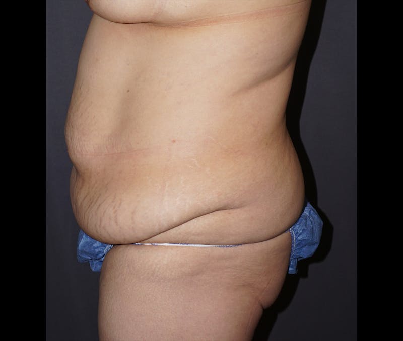 Tummy Tuck Before & After Gallery - Patient 169452 - Image 3