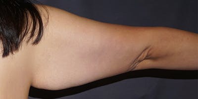 Brachioplasty Before & After Gallery - Patient 619466 - Image 1
