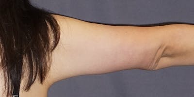 Brachioplasty Before & After Gallery - Patient 619466 - Image 2