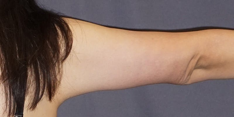 Brachioplasty Before & After Gallery - Patient 619466 - Image 2