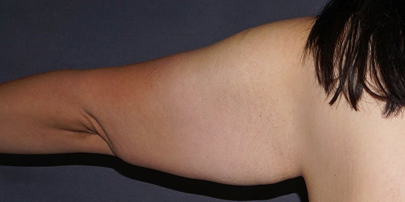 Brachioplasty Before & After Gallery - Patient 619466 - Image 3