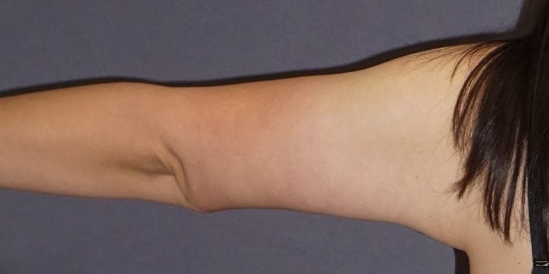 Brachioplasty Before & After Gallery - Patient 619466 - Image 4