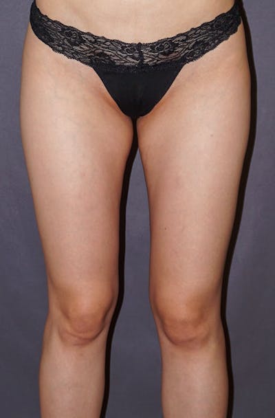 Liposuction Before & After Gallery - Patient 190573 - Image 2