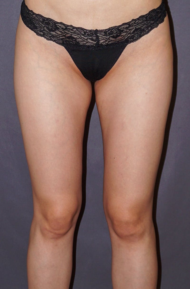 Liposuction Before & After Gallery - Patient 190573 - Image 2