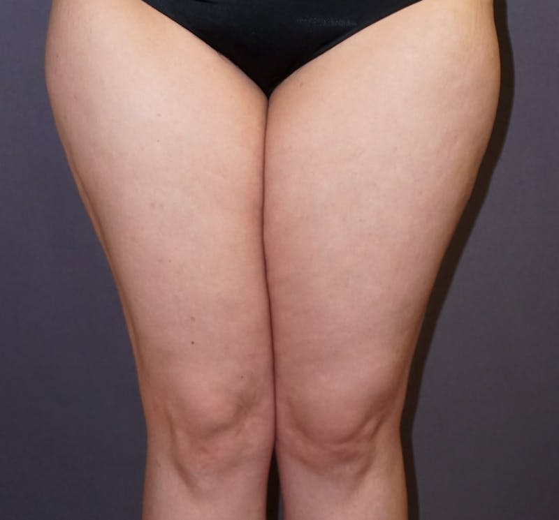 Liposuction Before & After Gallery - Patient 132915 - Image 3