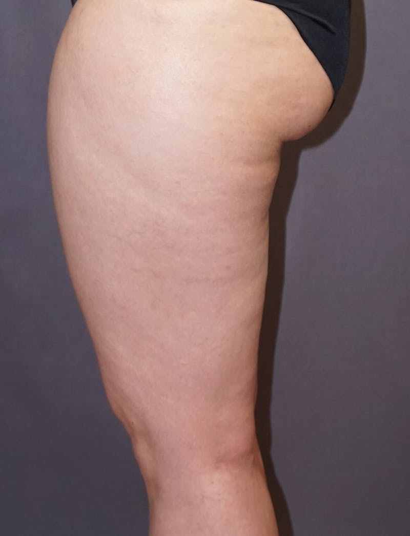 Liposuction Before & After Gallery - Patient 132915 - Image 5