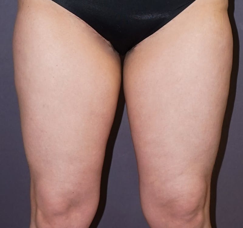 Liposuction Before & After Gallery - Patient 132915 - Image 1