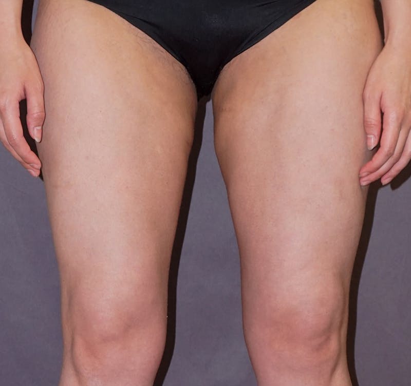 Liposuction Before & After Gallery - Patient 132915 - Image 2