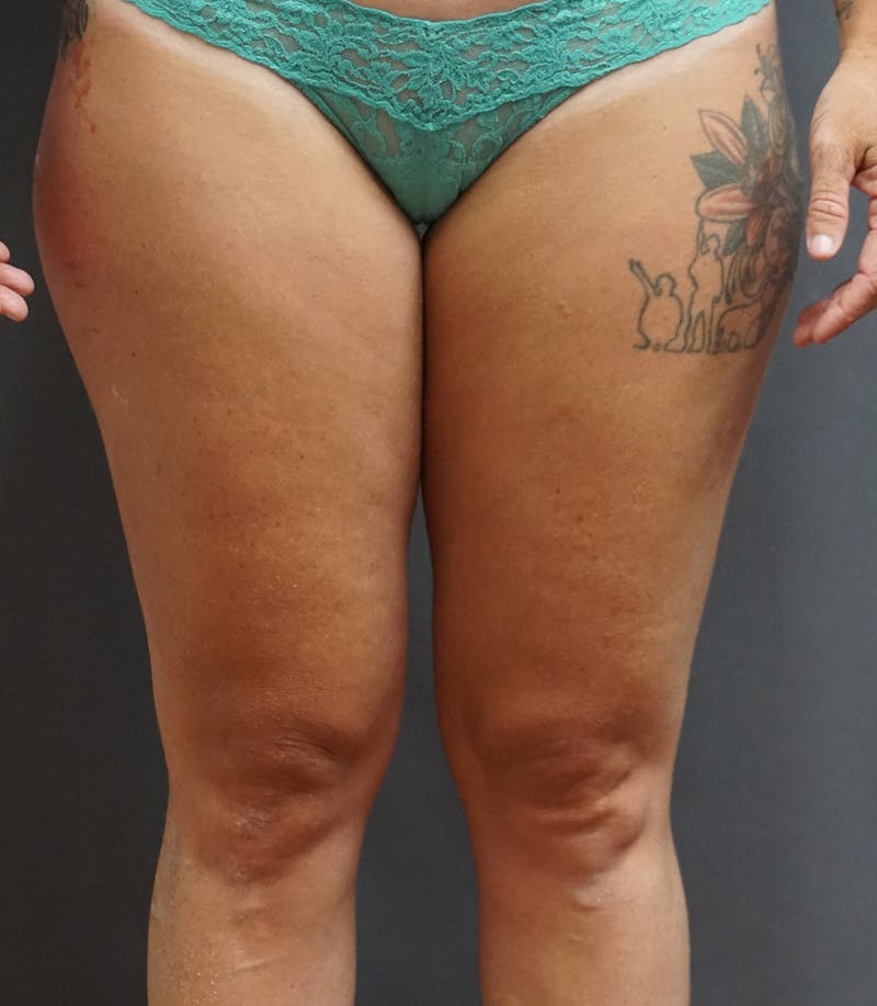 Liposuction Before & After Gallery - Patient 239679 - Image 1