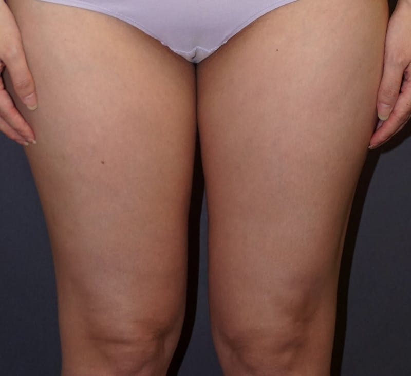Liposuction Before & After Gallery - Patient 403532 - Image 1