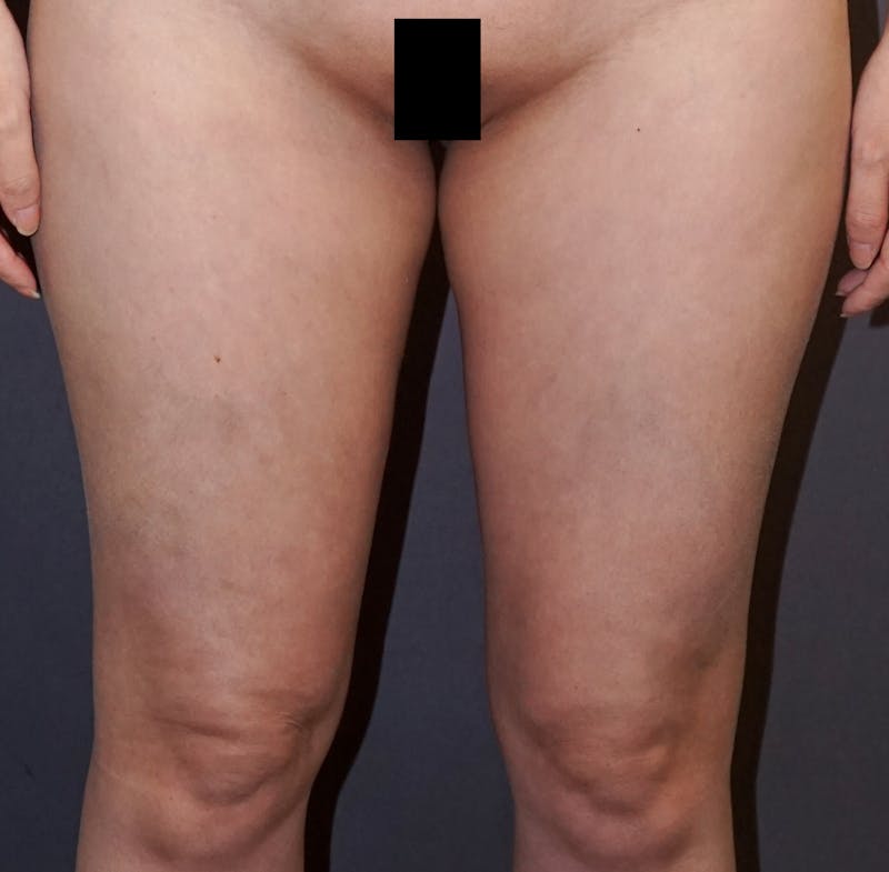 Liposuction Before & After Gallery - Patient 403532 - Image 2