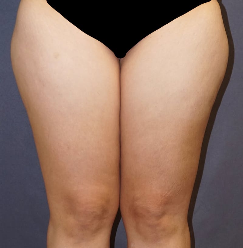 Liposuction Before & After Gallery - Patient 136338 - Image 1