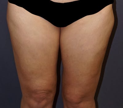 Liposuction Before & After Gallery - Patient 136338 - Image 2