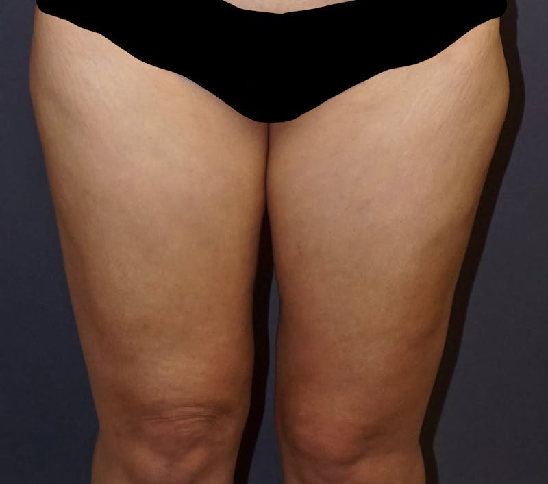 Liposuction Before & After Gallery - Patient 136338 - Image 2