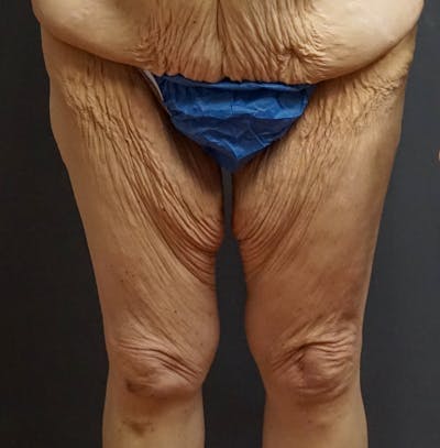 Thigh Lift Before & After Gallery - Patient 250420 - Image 1
