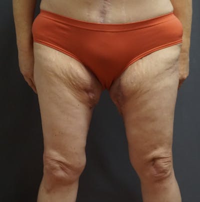 Thigh Lift Before & After Gallery - Patient 250420 - Image 2