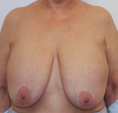 Breast Lift Before & After Gallery - Patient 423296 - Image 1